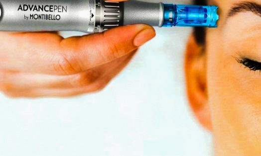 Microneedling